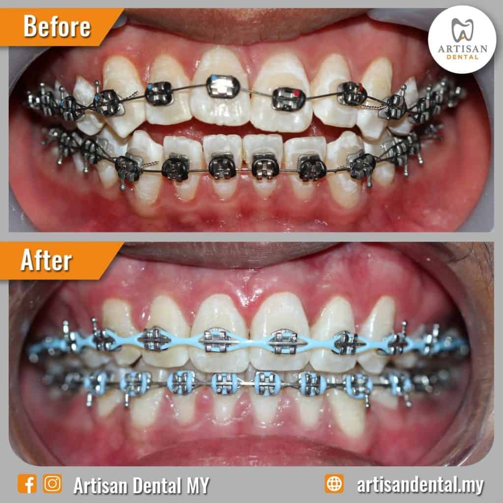 Conventional Braces Jenis, Fungsi dan Harga Artisan Dental