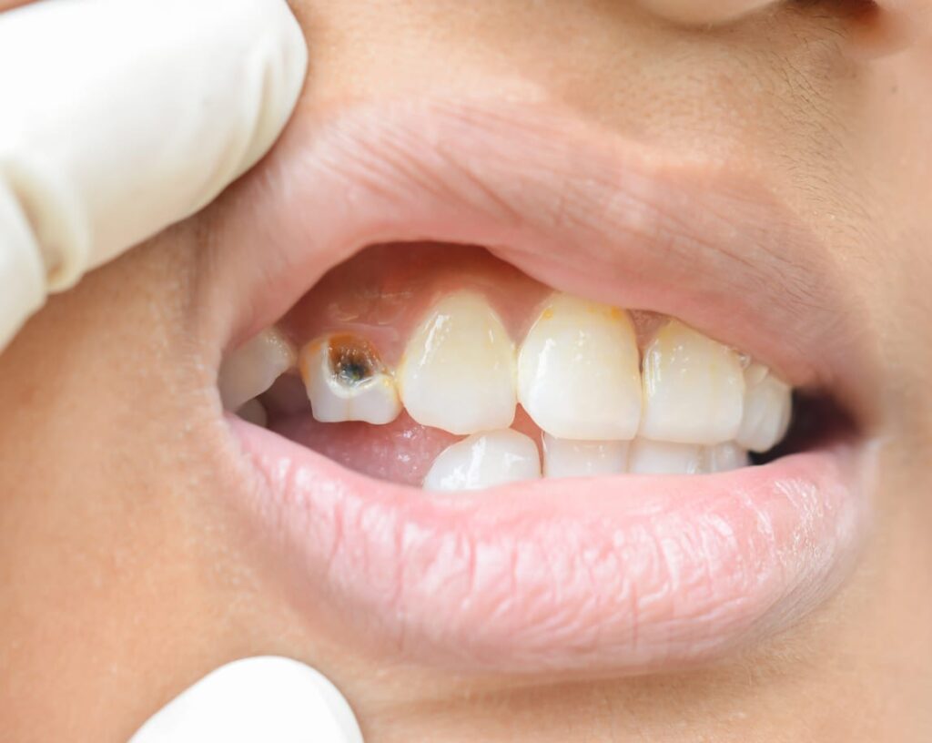 Harga Cabut Gigi di Klinik Swasta - Mahal Atau Murah? - Artisan Dental