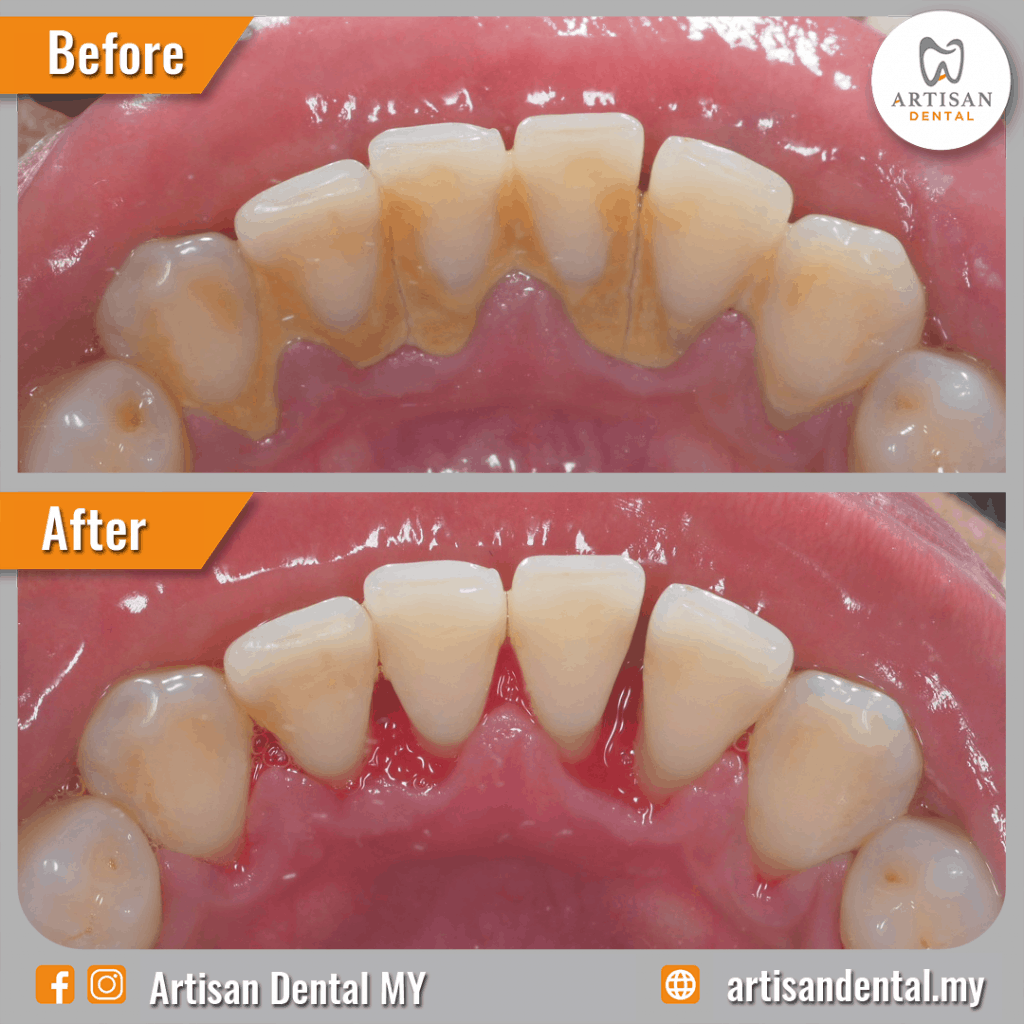 Scaling and Polishing Servis Paling Popular Artisan Dental